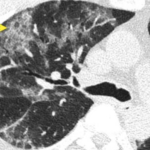 Radiologic Sign of the Day (CT) for COVID: Crazy Paving