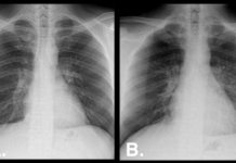 Basic Skill for Chest X-Rays: PA or AP?