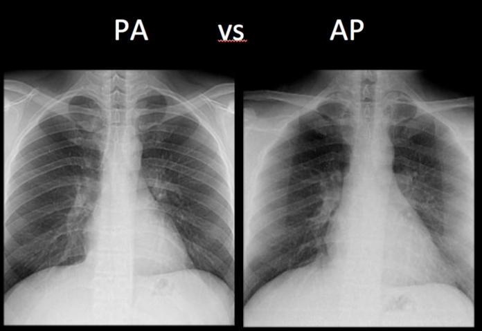 Chest X-Ray Basics: PA vs. AP - dermRounds Dermatology Network