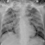 What does COVID look like on a chest xray?