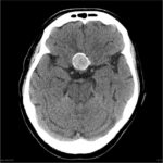 Case of the Day: Brain Mass on CT