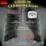 How to read a COVID-19 Chest X-Ray – visual guide
