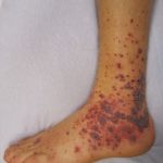 Medication Induced Vasculitis