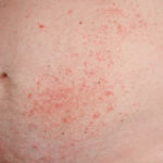 Dermatitis herpetiformis