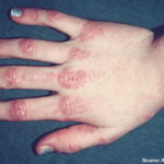 Dermatomyositis
