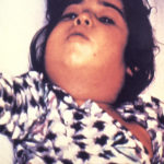 Diphtheria “bull neck”