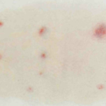 Rashes Could be a Symptom of Coronavirus