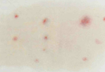 Rashes Could be a Symptom of Coronavirus