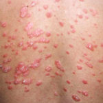 Guttate psoriasis