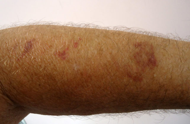 lichen-planus-dermrounds-dermatology-network