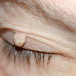 Skin Tag on Eyelid