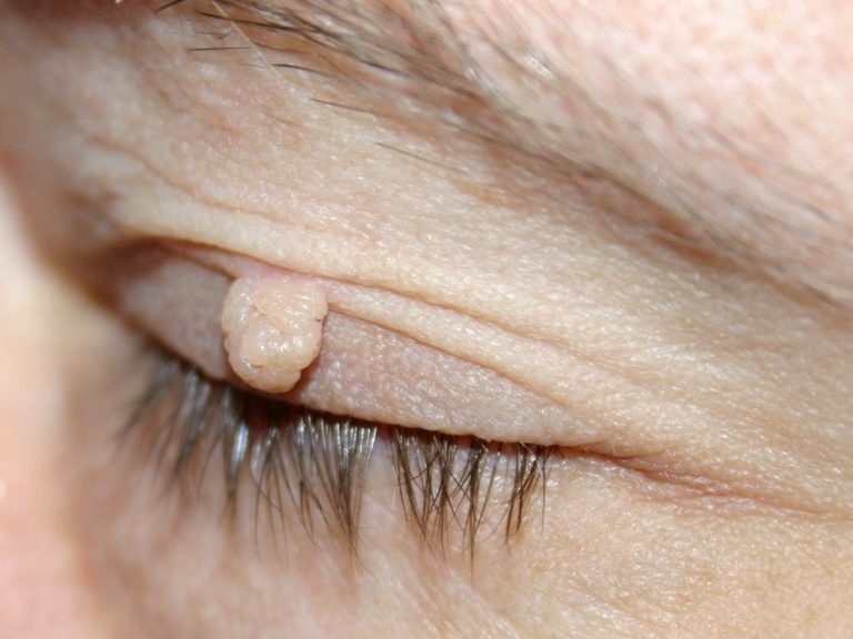 skin tags on eyelids bentadine