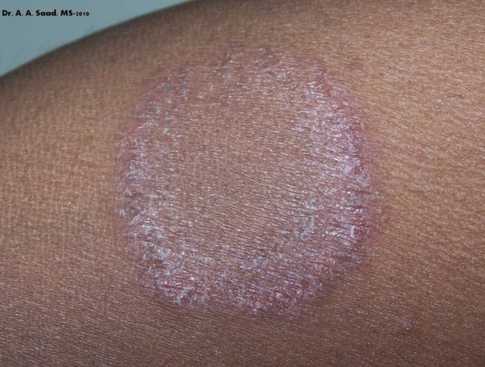 Tinea Corporis - dermRounds Dermatology Network