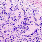 Schwannoma, histopathology, high mag.