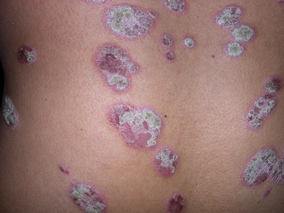 Psoriasis Dermrounds Dermatology Network