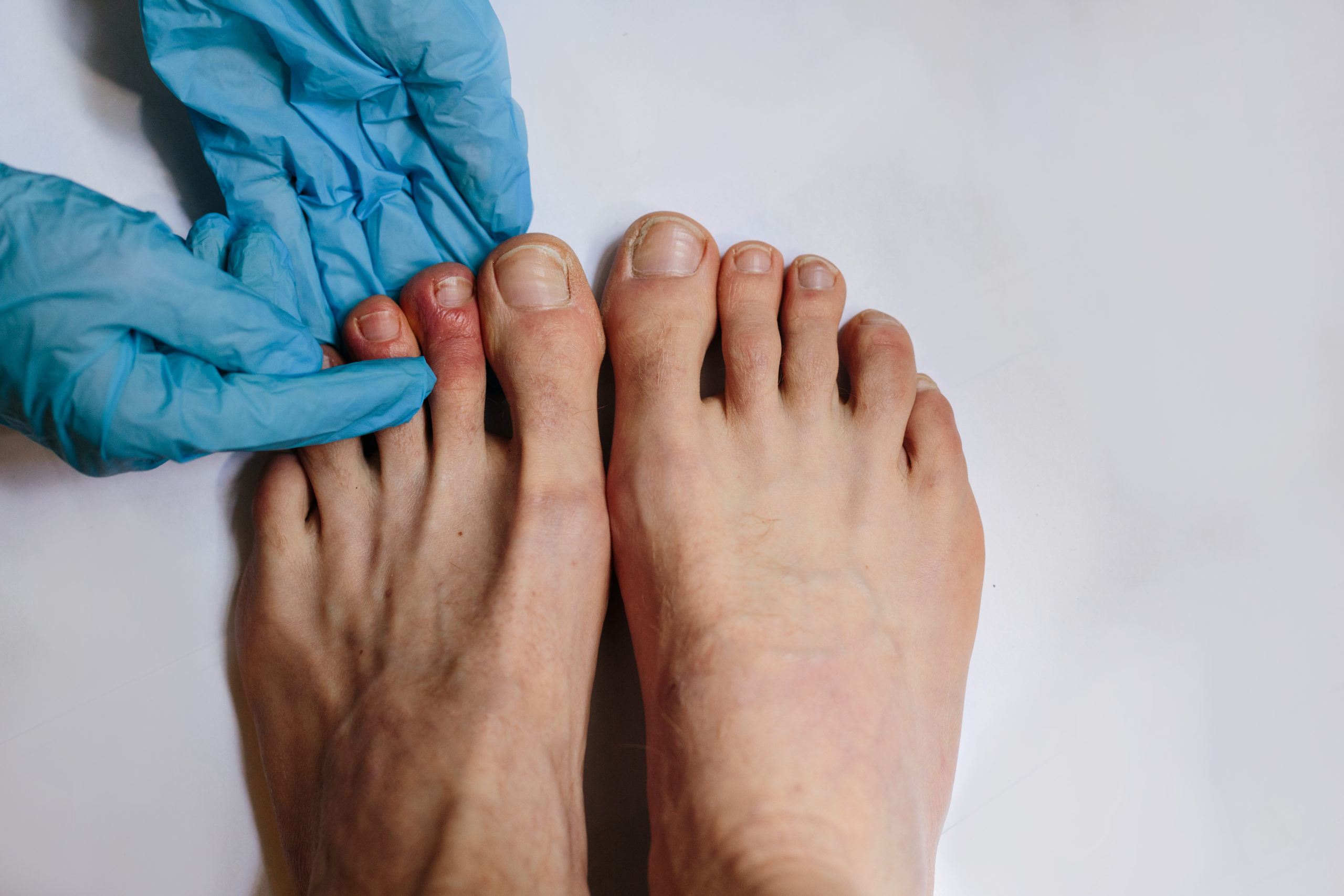 Синдром ковидные пальцы на ногах