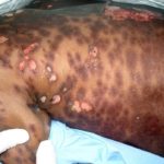 Stevens-Johnson Syndrome