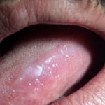 Verruca Vulgare (tongue)