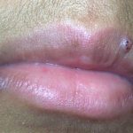 Verruca Vulgaris (lips)