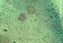 Pityriasis Versicolor (KOH examination)