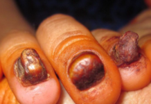 Pachyonychia congenita